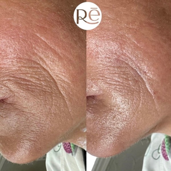 Dermal and lip filler result 30 at ReViVe Aesthetics & Healthcare