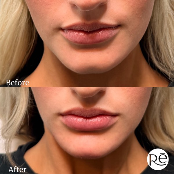 Dermal and lip filler result 31 at ReViVe Aesthetics & Healthcare