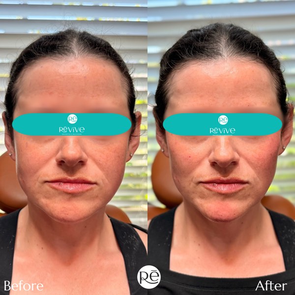 Dermal and lip filler result 32 at ReViVe Aesthetics & Healthcare