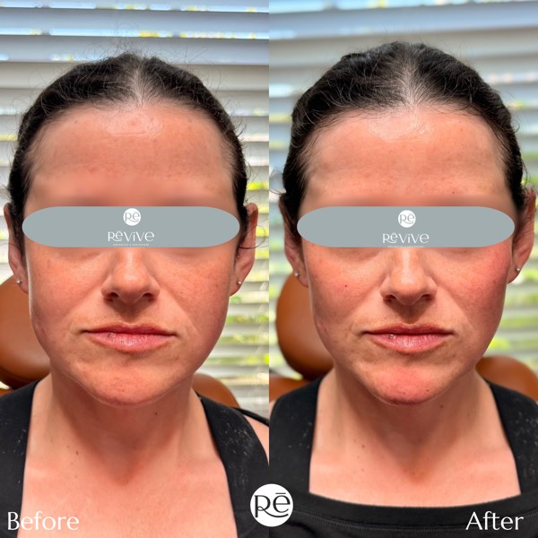 Dermal and lip filler result 33 at ReViVe Aesthetics & Healthcare