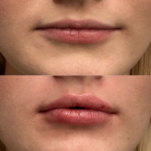 Dermal and lip filler result 34 at ReViVe Aesthetics & Healthcare