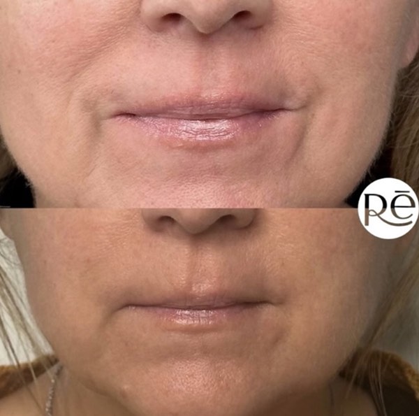 Dermal and lip filler result 35 at ReViVe Aesthetics & Healthcare
