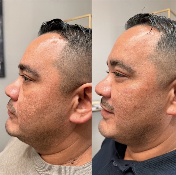 Dermal and lip filler result 36 at ReViVe Aesthetics & Healthcare