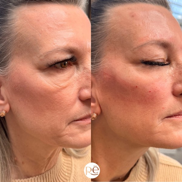 Dermal and lip filler result 37 at ReViVe Aesthetics & Healthcare
