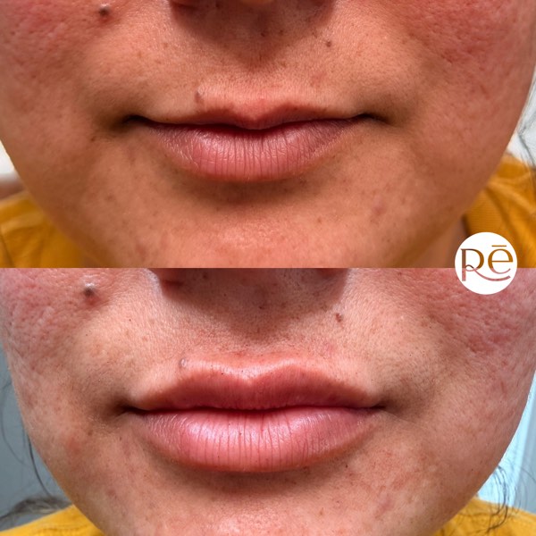 Dermal and lip filler result 38 at ReViVe Aesthetics & Healthcare