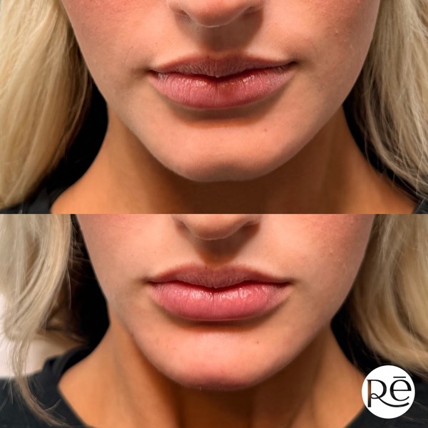 Dermal and lip filler result 39 at ReViVe Aesthetics & Healthcare