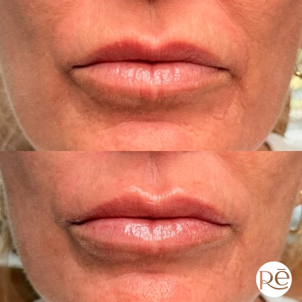 Dermal and lip filler result 40 at ReViVe Aesthetics & Healthcare