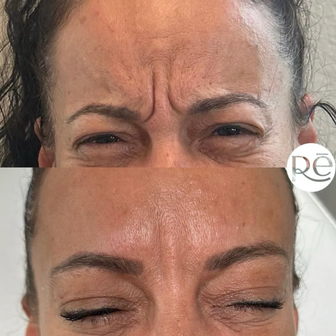Real Botox before and after results at ReViVe Aesthetics
