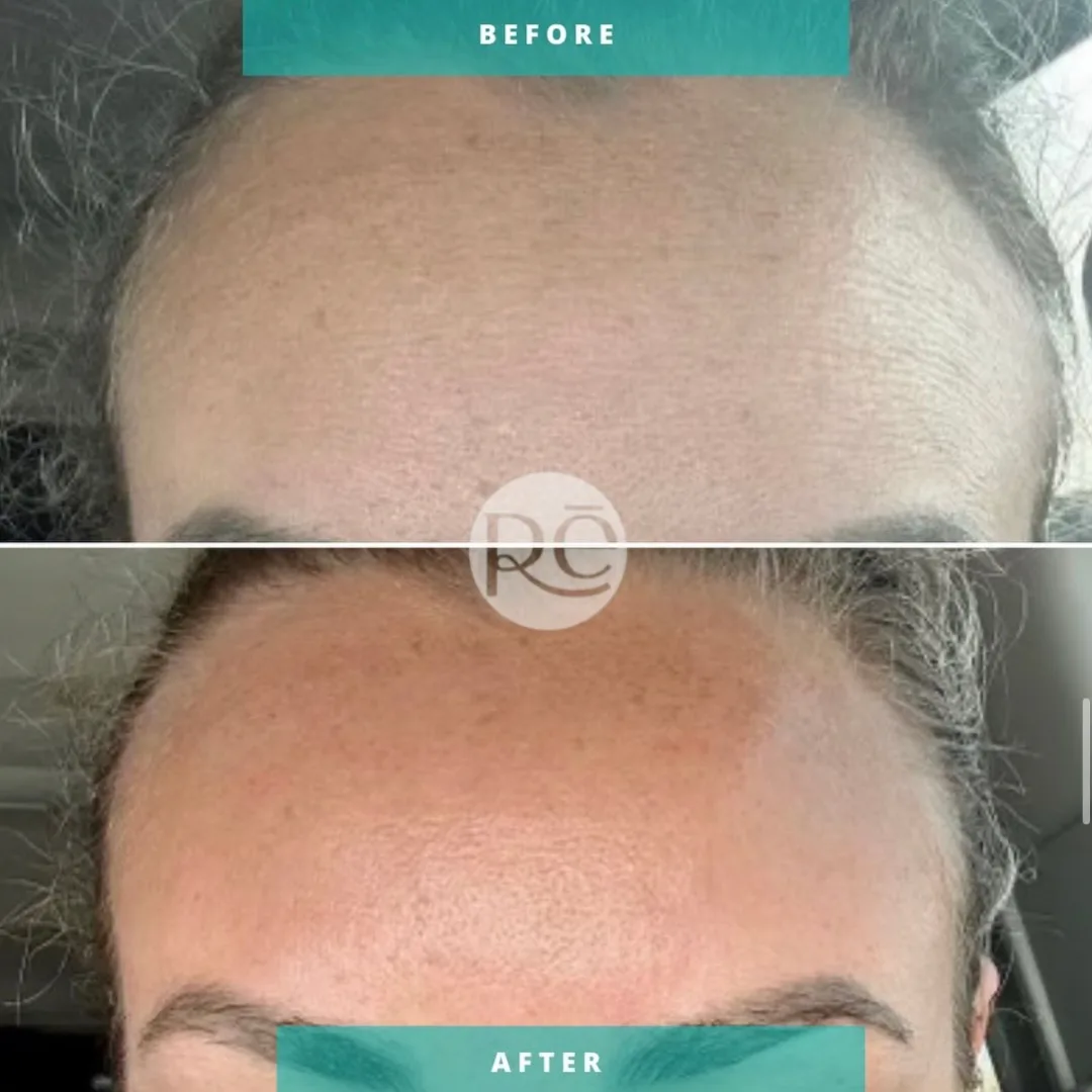 Real Signature ReViVe Facial before and after results at ReViVe Aesthetics