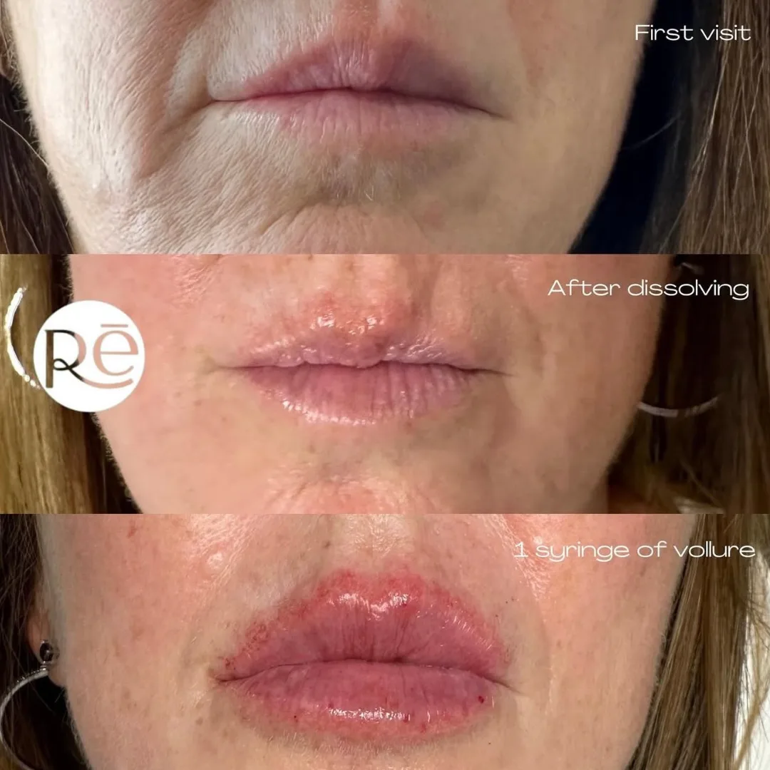 Real Lip Filler before and after results at ReViVe Aesthetics