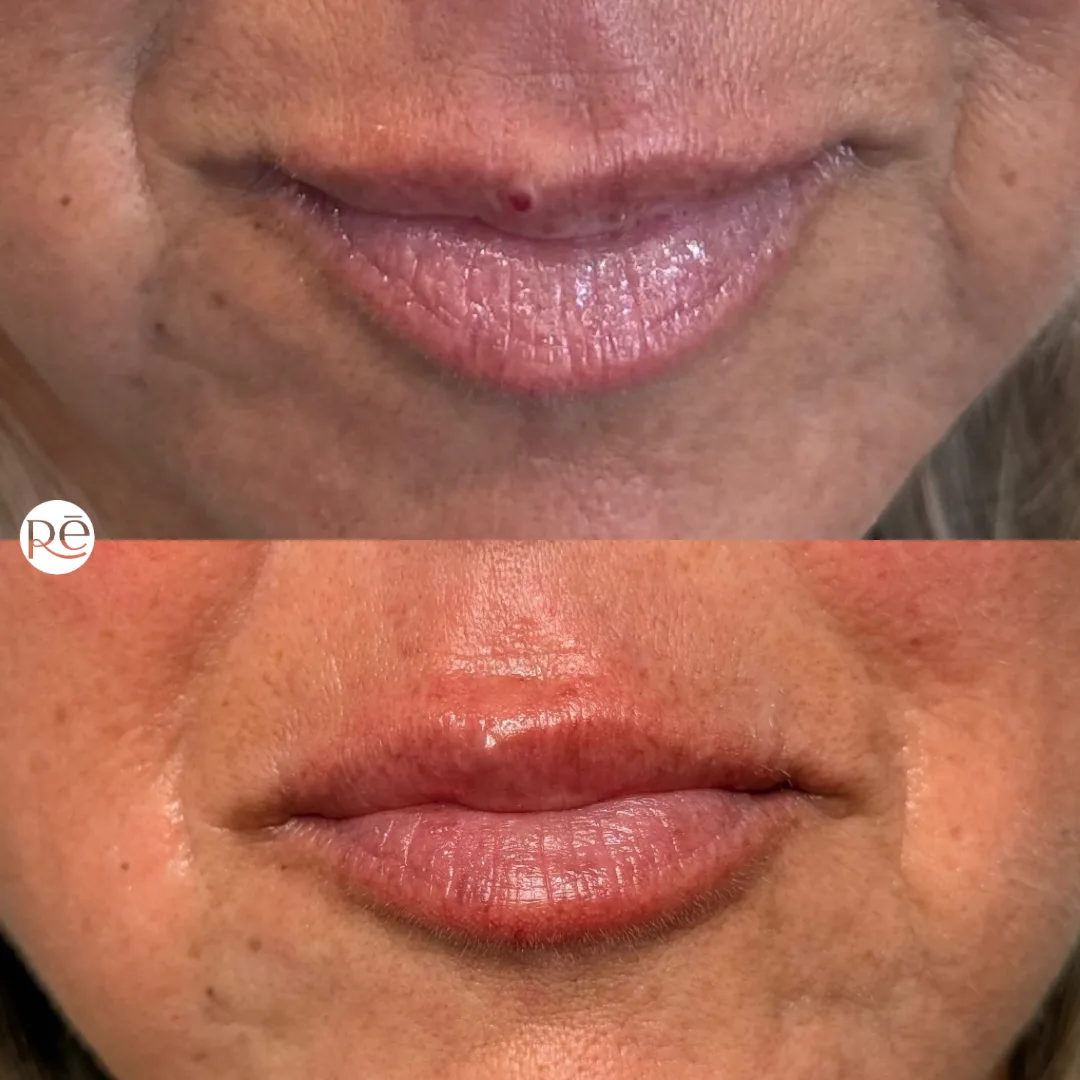 Real Lip Filler before and after results at ReViVe Aesthetics